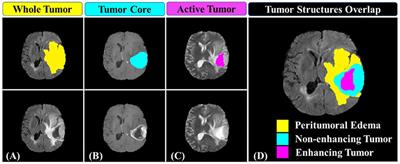 A Multi-parametric MRI-Based Radiomics Signature and a Practical ML Model for Stratifying Glioblastoma Patients Based on Survival Toward Precision Oncology